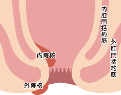 痔核（イボ痔）